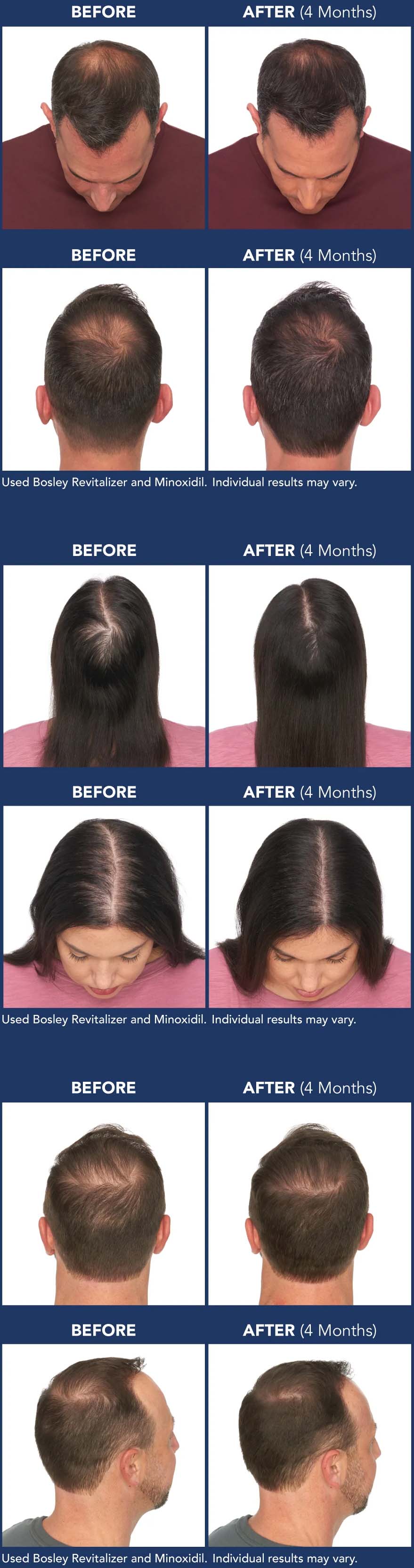 After four months, men and women achieved noticeable results while also using Minoxidil. Individual results may vary