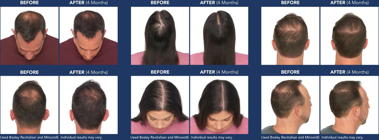 After four months, men and women achieved noticeable results while also using Minoxidil. Individual results may vary