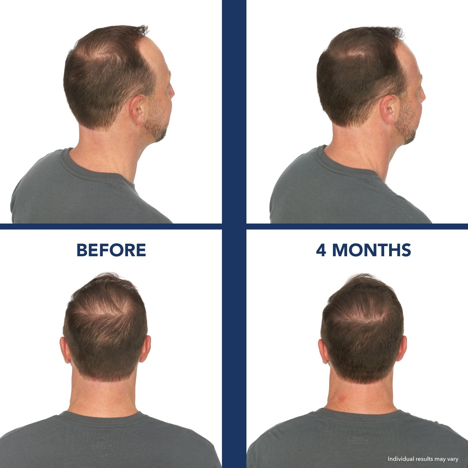 Bosley Revitalizer Flex Bosley Online Store